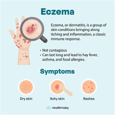 Is Eczema Autoimmune