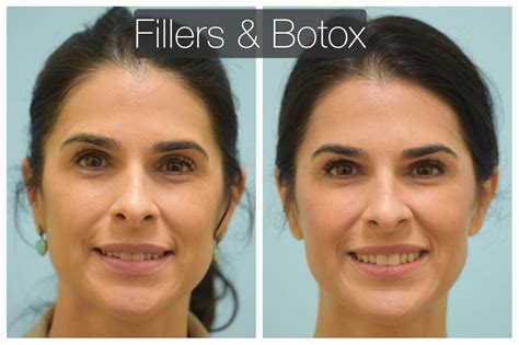First time Botox and Fillers (mainly around the eyes and temples), very natural with and without ...