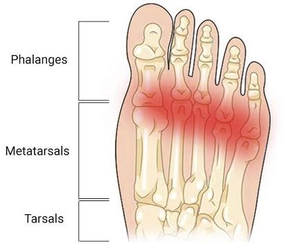 Ball of Foot Pain Running 的图像结果