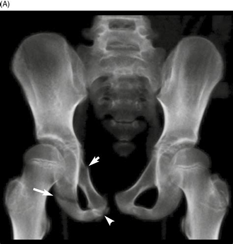 Bucket Handle Fracture