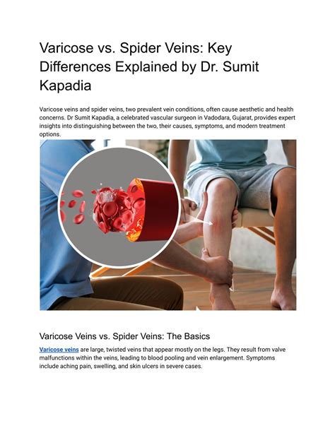 PPT - Varicose vs. Spider Veins_ Key Differences Explained by Dr. Sumit Kapadia PowerPoint ...