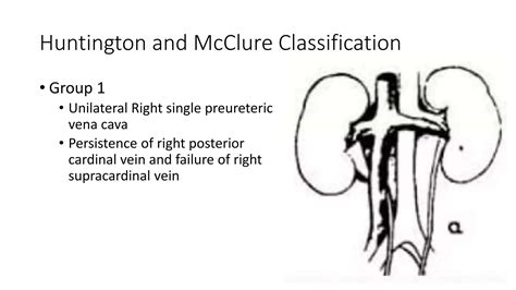 Retrocaval Ureter Urology Anatomy and Management | PPTX