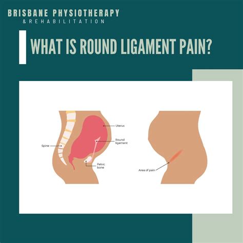 Round ligament pain: How to manage it | Brisbane Physiotherapy & Podiatry posted on the topic ...