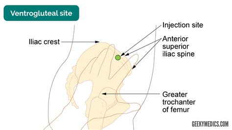 INJECTION INTRAMUSCULAIRE
