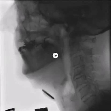 Figure 48 from Conventional radiology in the study of dysphagia. The ...