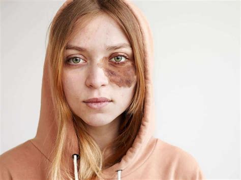 Meanings of Birthmark in Eye [Right or Left Eye Freckle] - What Spiritual