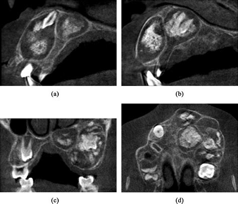 An international collaborative study of 105 new cases of adenomatoid odontogenic tumors - Oral ...