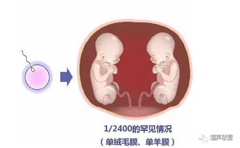同卵双胞胎的天敌-双胎输血综合征 - 知乎
