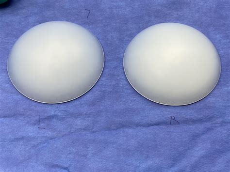 Plastic Surgery Case Study - Male Buttock Augmentation with 400cc Intramuscular Implants ...