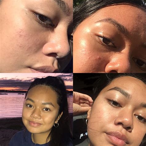 [B&A] One month since I was prescribed Differen Gel and doxycycline tablets. Nothing has worked ...