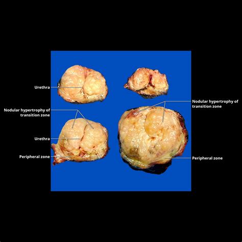 Column of Bertin, Kidney | Radiology Key