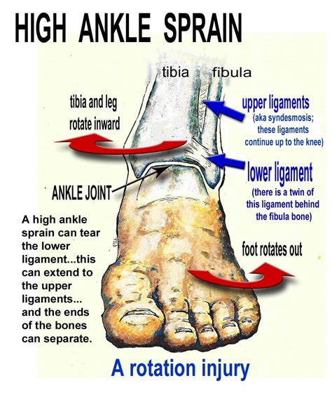 Ankle Sprains: Causes, Symptoms, And Treatment - EndurElite