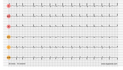 Ecg Blocks Quiz at Susan Pittman blog