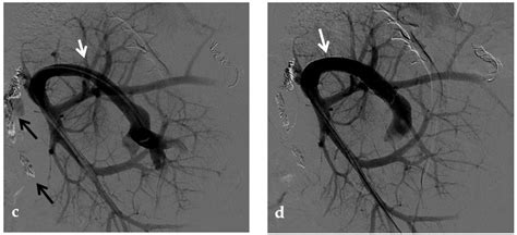 The Role of Imaging in Portal Vein Thrombosis: From the Diagnosis to the Interventional ...