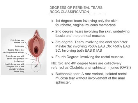 RISK FACTORS,EVALUATION AND MANAGEMENT OF PERINEAL TEARS | PPT