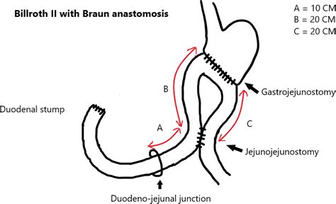 Severe acute pancreatitis in the early postoperative period due to afferent loop syndrome ...