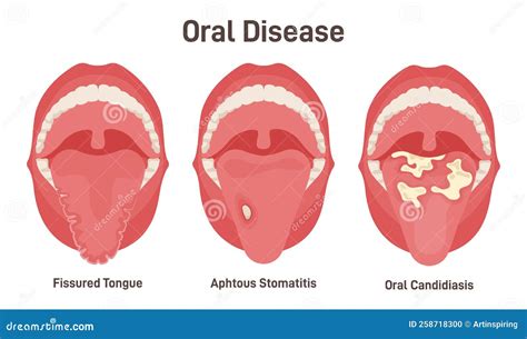 Tongue Problems Set. Fissured Tongue, Oral Candidiasis and Aphthous Stock Vector - Illustration ...