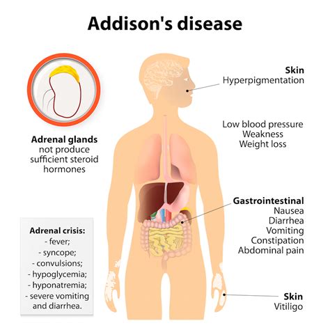 Addison's disease adrenaline - dasteb