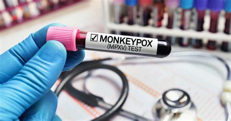 Monkeypox: 5 things doctors want you to know about safety and ...