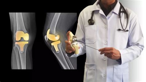 Gold Knee Implant Helps Nurse Return to Work After Severe Knee Pain ...