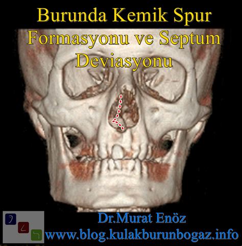 Health Zone Turkey: Nasal Bone Spur - Symptoms, Diagnosis, Treatment