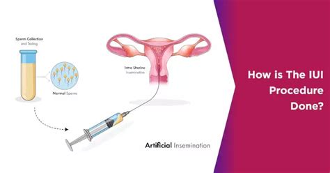 How Is IUI Procedure Done 的图像结果