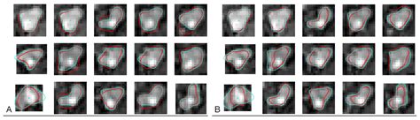 Using Deep Learning and B-Splines to Model Blood Vessel Lumen from 3D ...