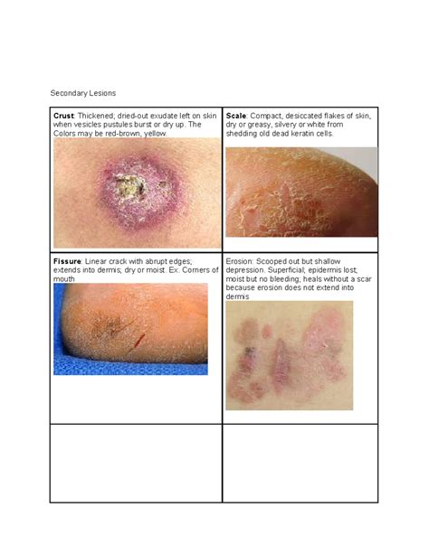 Crust Lesion Definition at Leona Freedman blog