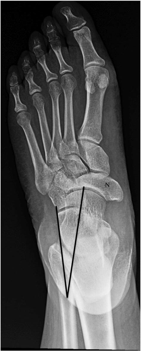 Syndrome De Müller Weiss Pied: Maladie De Rafael Nadal – XESUQ