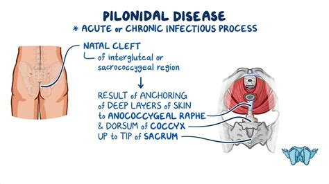 Video: Pilonidal disease: Clinical sciences | Osmosis