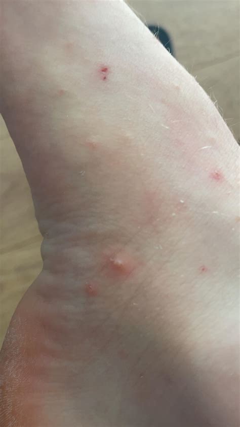 Uncontrollable itching : r/medical_advice