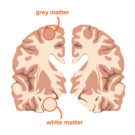 Vascular Dementia Vascular Dementia Dementia Care