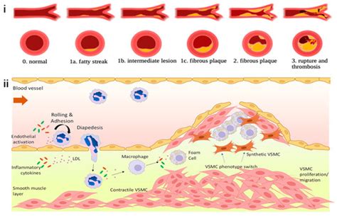 Photodynamic Therapy for Atherosclerosis: Past, Present, and Future