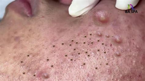 Image result for Largest Infected Exploding Cyst Carbuncle Blackhead