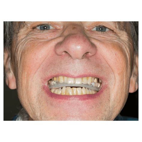 Image result for teeth grinding