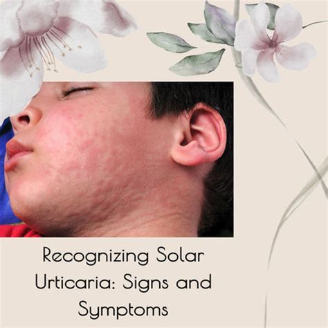 Unveiling Solar Urticaria: A Guide to Sun-Induced Skin Sensitivity ...
