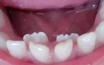 6岁孩子换牙时 牙齿长得很丑不整齐怎么办？