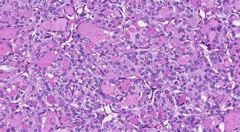 Your pathology report for infiltrative follicular variant papillary thyroid carcinoma ...