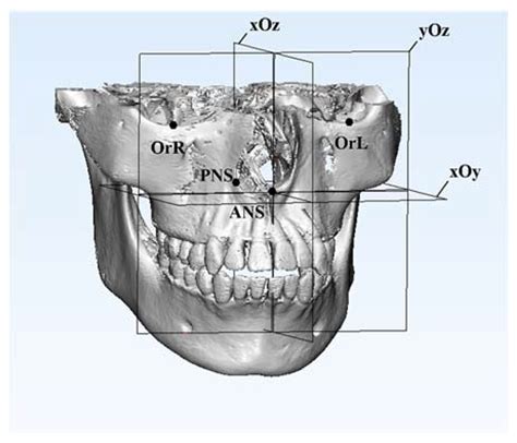 A Novel Method to Combine Maxilla-Based Coordinate System and ...