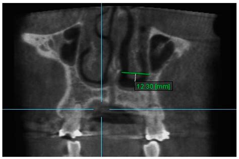 Three-Dimensional Cone-Beam Computed Tomography Evaluation of Changes ...