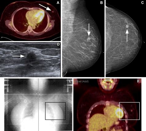 Breast Cancer Screening in Survivors of Childhood Cancer | RadioGraphics