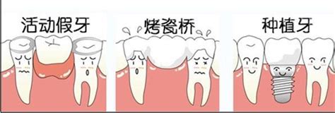 牙齿缺损-断牙如何有效修复？_大连康贝佳口腔