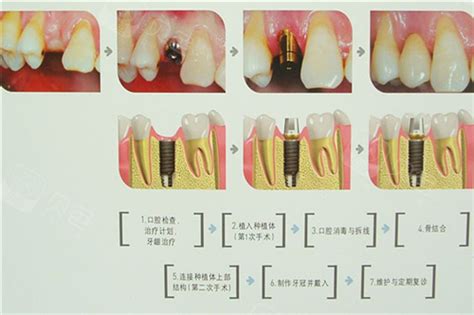 武汉哪些口腔机构可以做种植牙？种植牙全流程整理 - 知乎