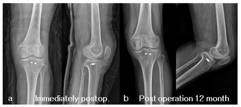 Tibial Tuberosity Fracture