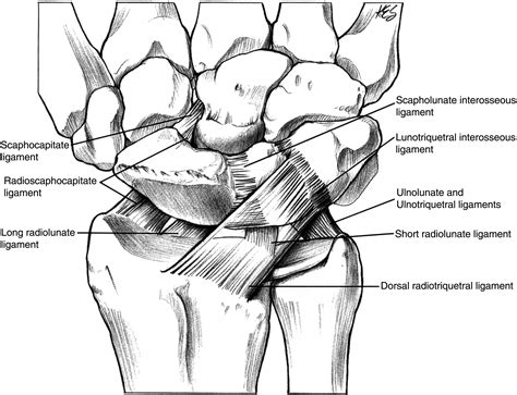 Scapholunate Ligament Repair With Capsulodesis Reinforcement - Journal ...