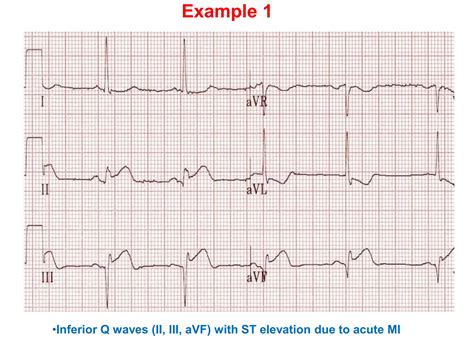 Q WAVE IN ECG,CAUSES OF PATHOLOGICAL Q WAVES | PPTX