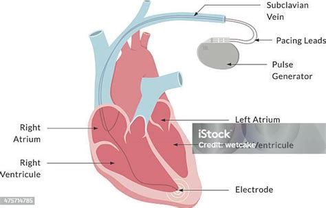 Pacemaker Procedure 的图像结果
