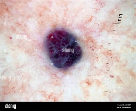 Dermatoscope image of a hemangioma on a patient's skin. Haemangiomas ...