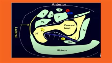 How to Perform Hip Ultrasound 的图像结果