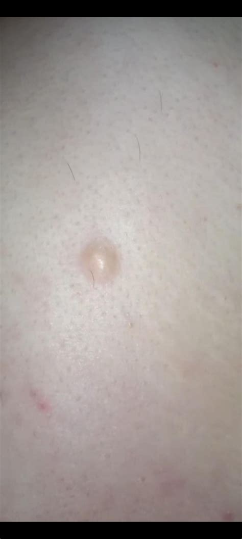 When To Be Concerned About A Lump Under Skin at Charlotte Mcgowan blog